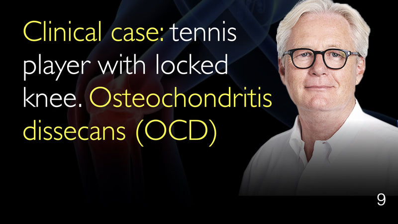 Klinischer Fall. Tennisspieler mit gesperrtem Knie. Osteochondritis dissecans (OCD). 9
